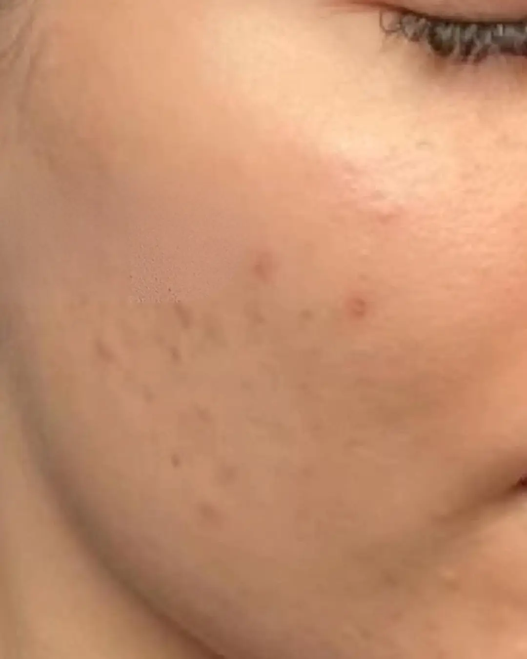 بعد علاج آثار حب الشباب