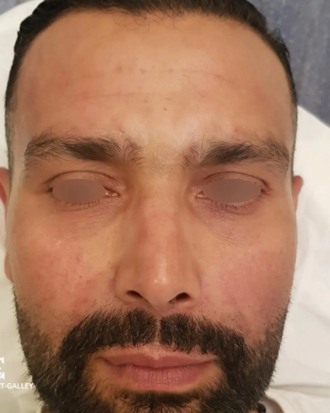 بعد حقن البوتوكس في الجبهة