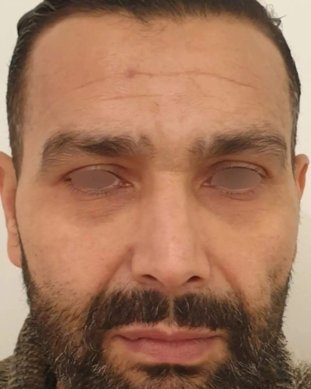 قبل حقن البوتوكس في الجبهة