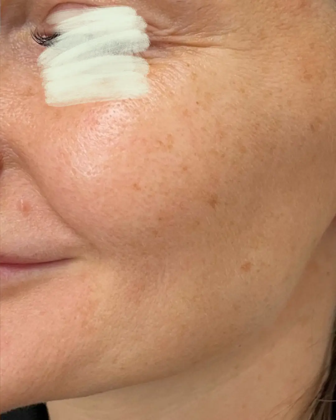 بعد تجديد البشرة بالليزر