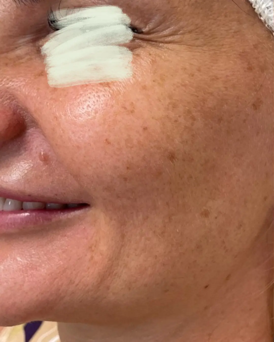 قبل تجديد البشرة بالليزر