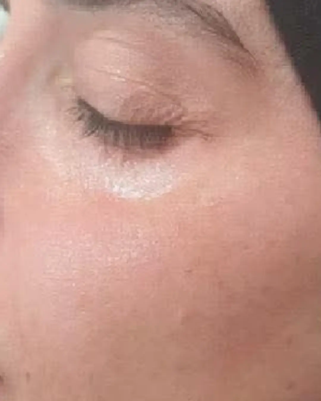 بعد إزالة التصبغات